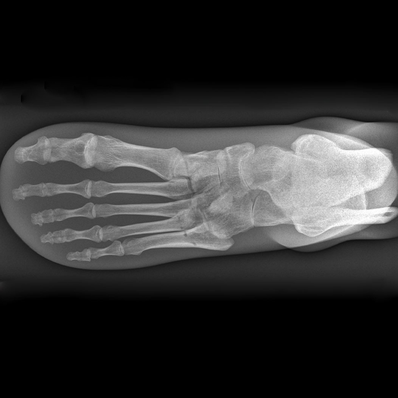 QUART X-Ray Foot Phantom 