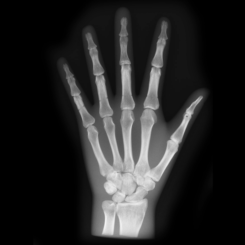 QUART X-Ray Hand Phantom