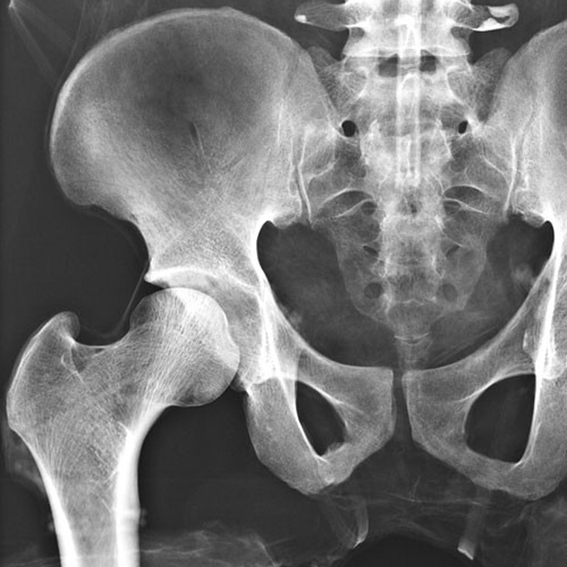 QUART X-Ray Hip Phantom 