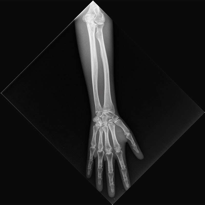 QUART X-Ray Arm Phantom