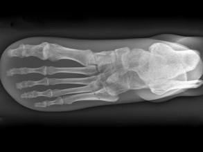 QUART X-Ray Foot Phantom 