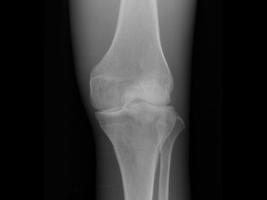 QUART Dental X-Ray Knee Phantom 